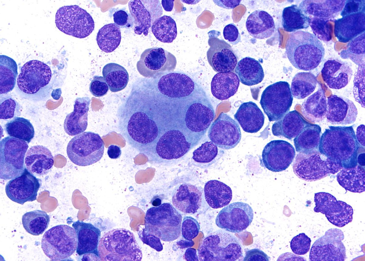 Bone marrow - Dysmegakaryopoiesis.